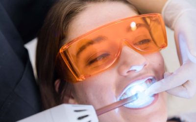 Consejos que no debes olvidar si quieres hacerte un blanqueamiento dental