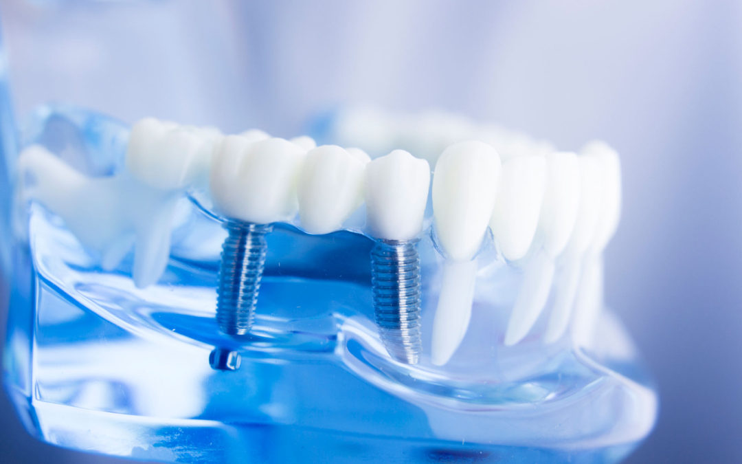 Implantologia dental