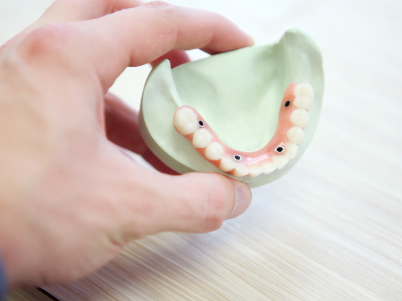 Catarroja-Dental-implantes-dentales