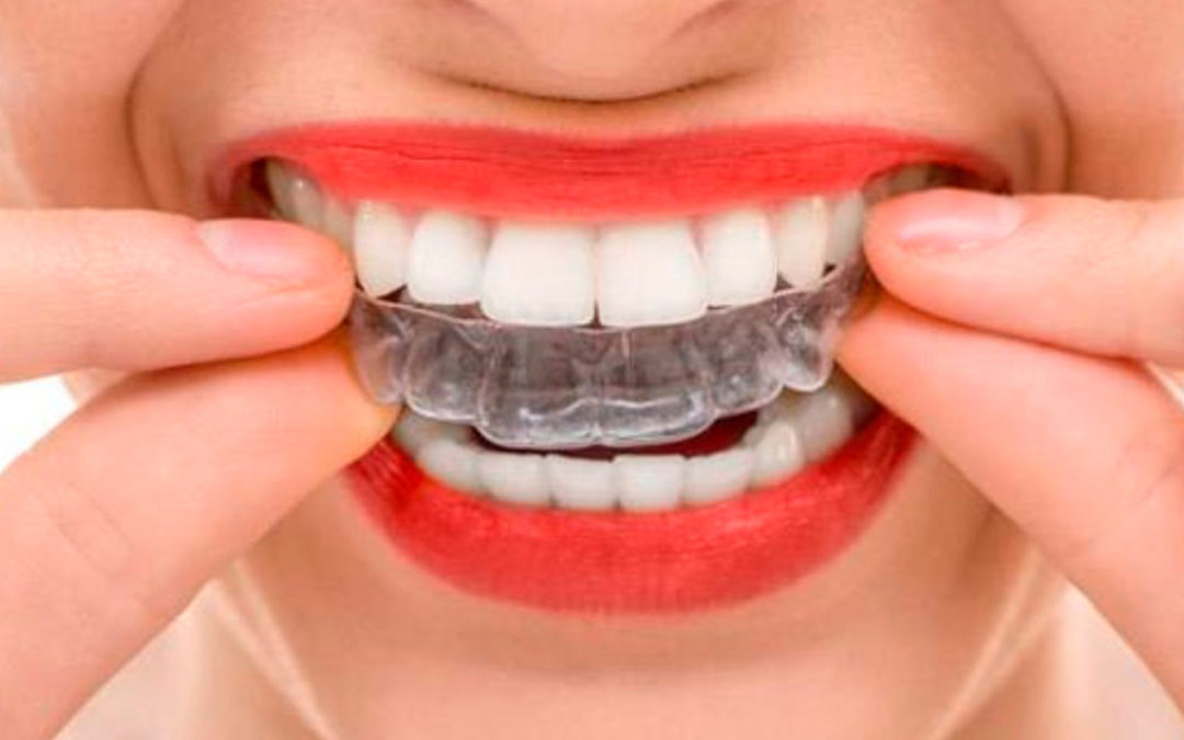 Blanqueamiento dental desde la comodidad de tu casa