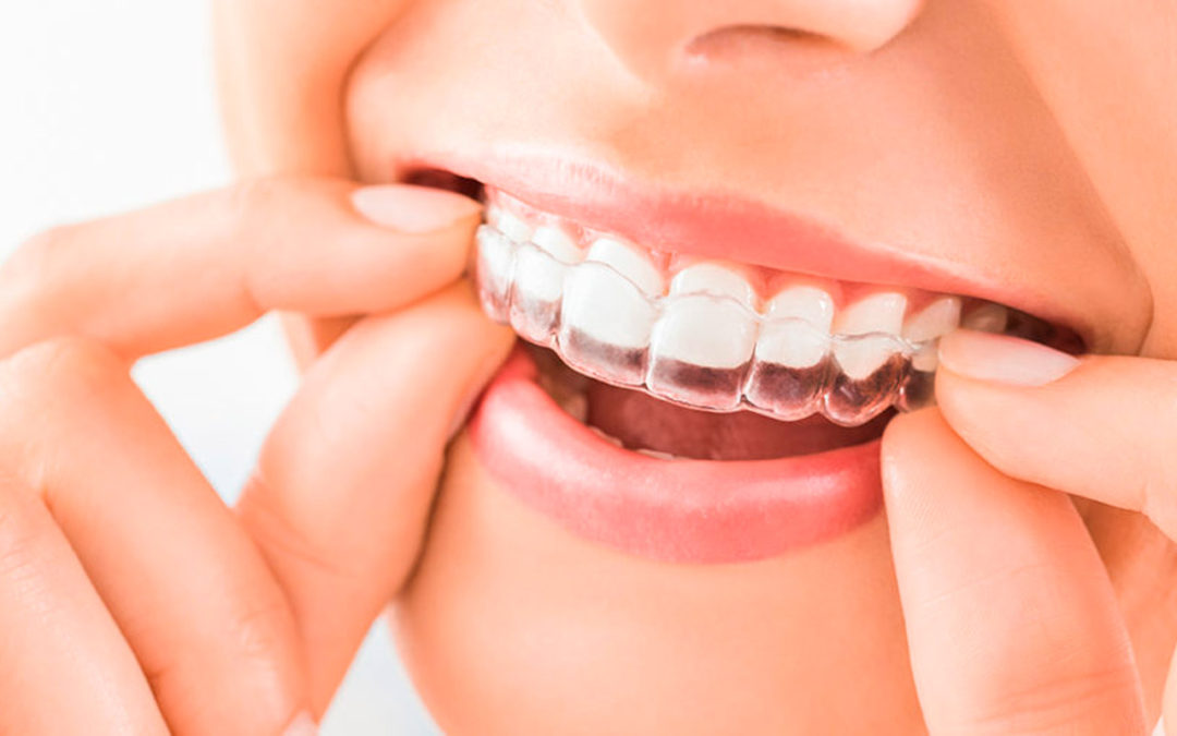 ¡Imperdible Invisalign Day!