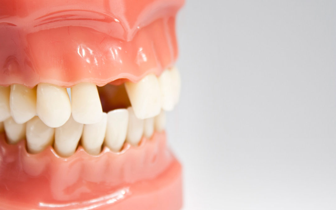 ¿Hay relación entre la Covid y la pérdida de dientes?
