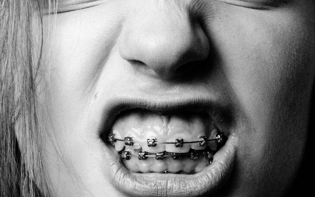 Lo que no debes comer si llevas brackets