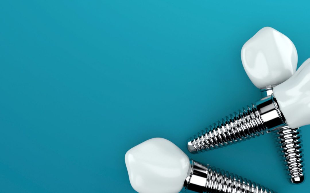 Implantes dentales en Malilla. La guía completa