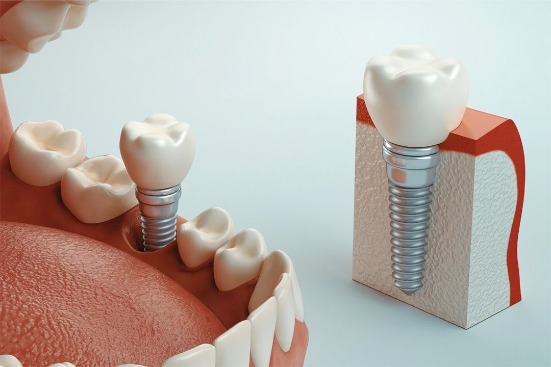 implantes dentales en Malilla