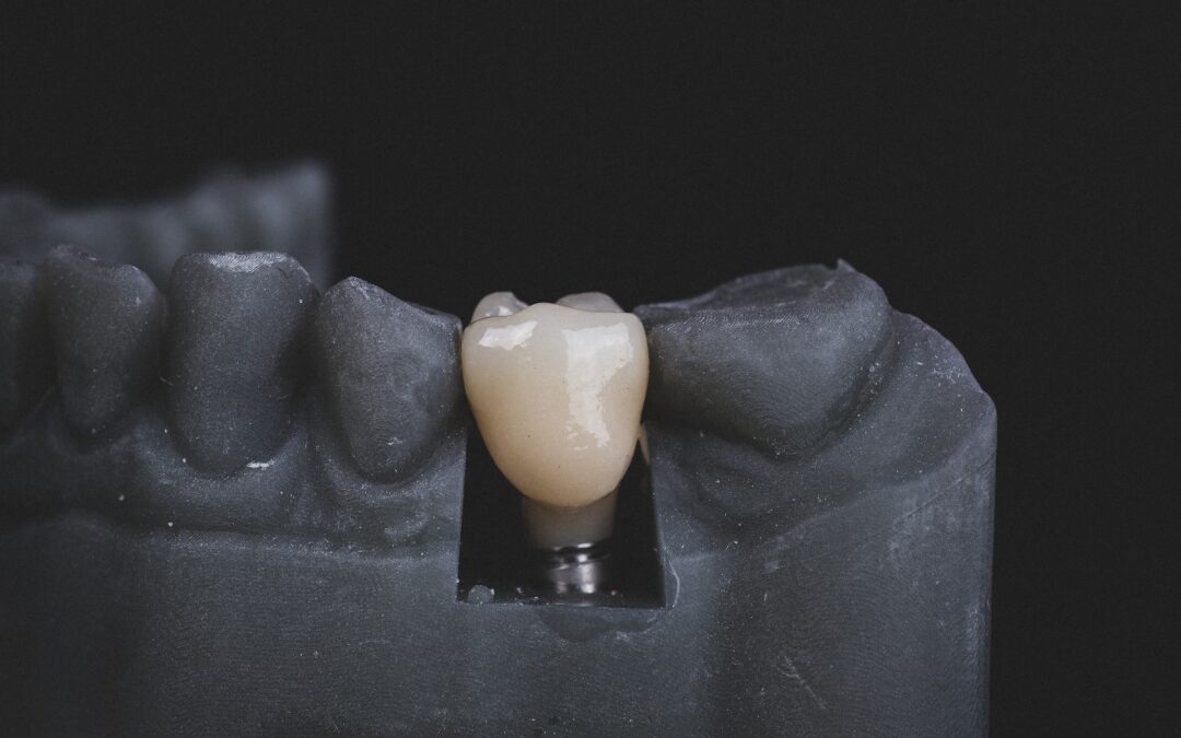 Tipos de implantes dentales