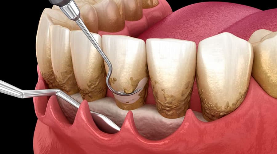 modelo de un implante dental